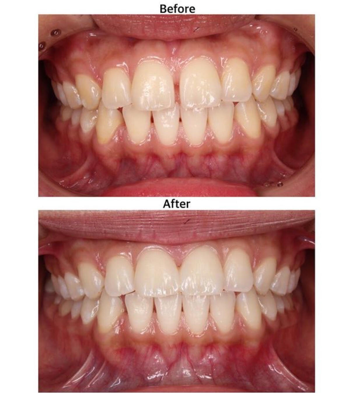 ダイレクトボンディング