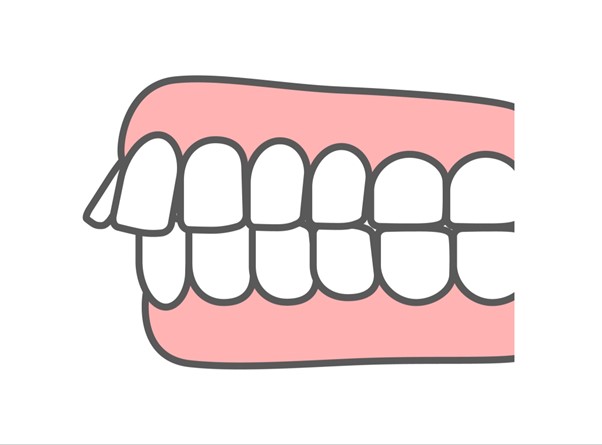 出っ歯　上顎前突