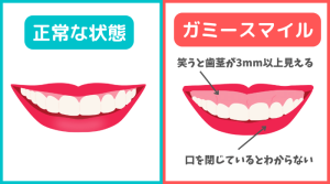 ガミースマイル