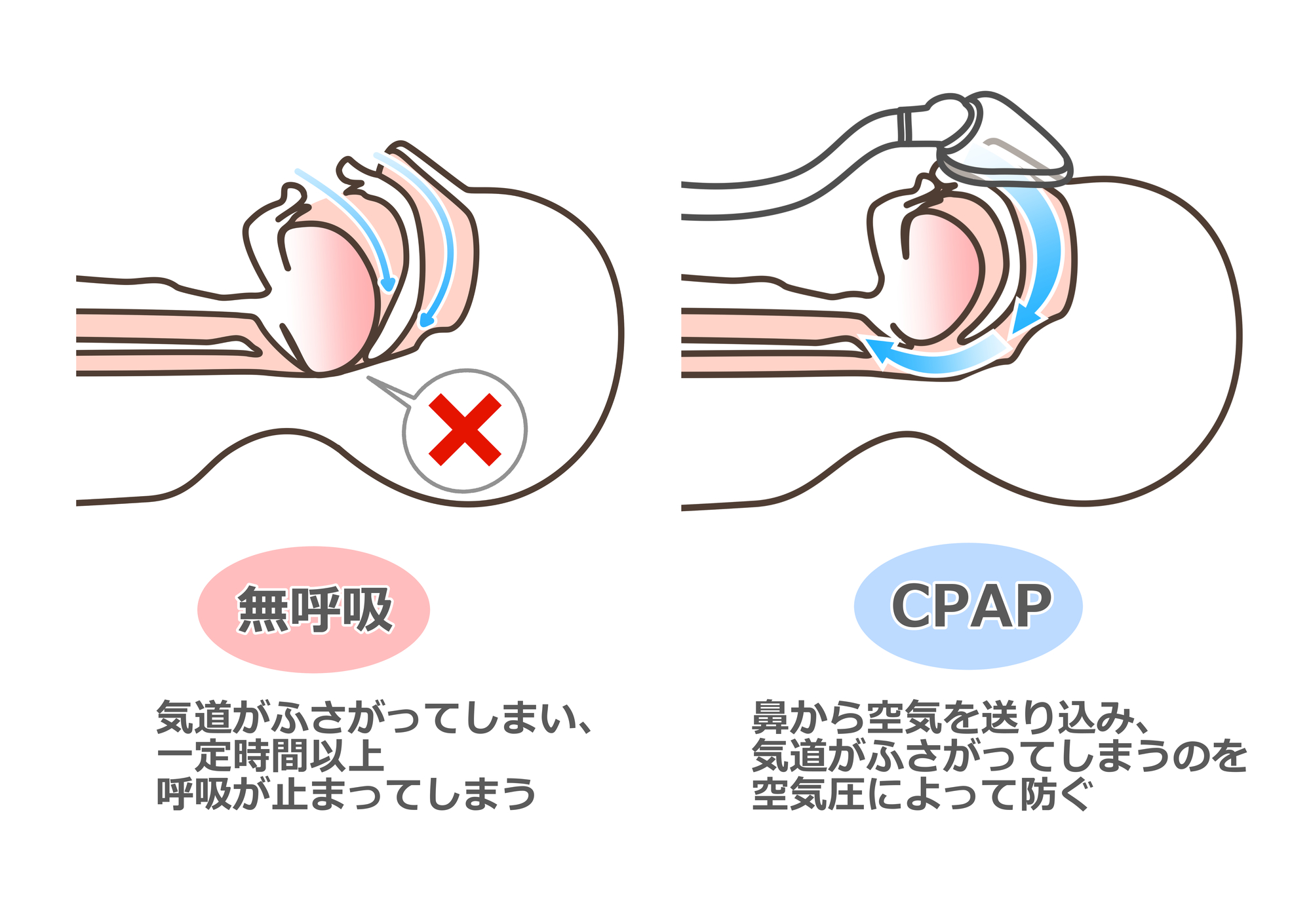 CPAP　