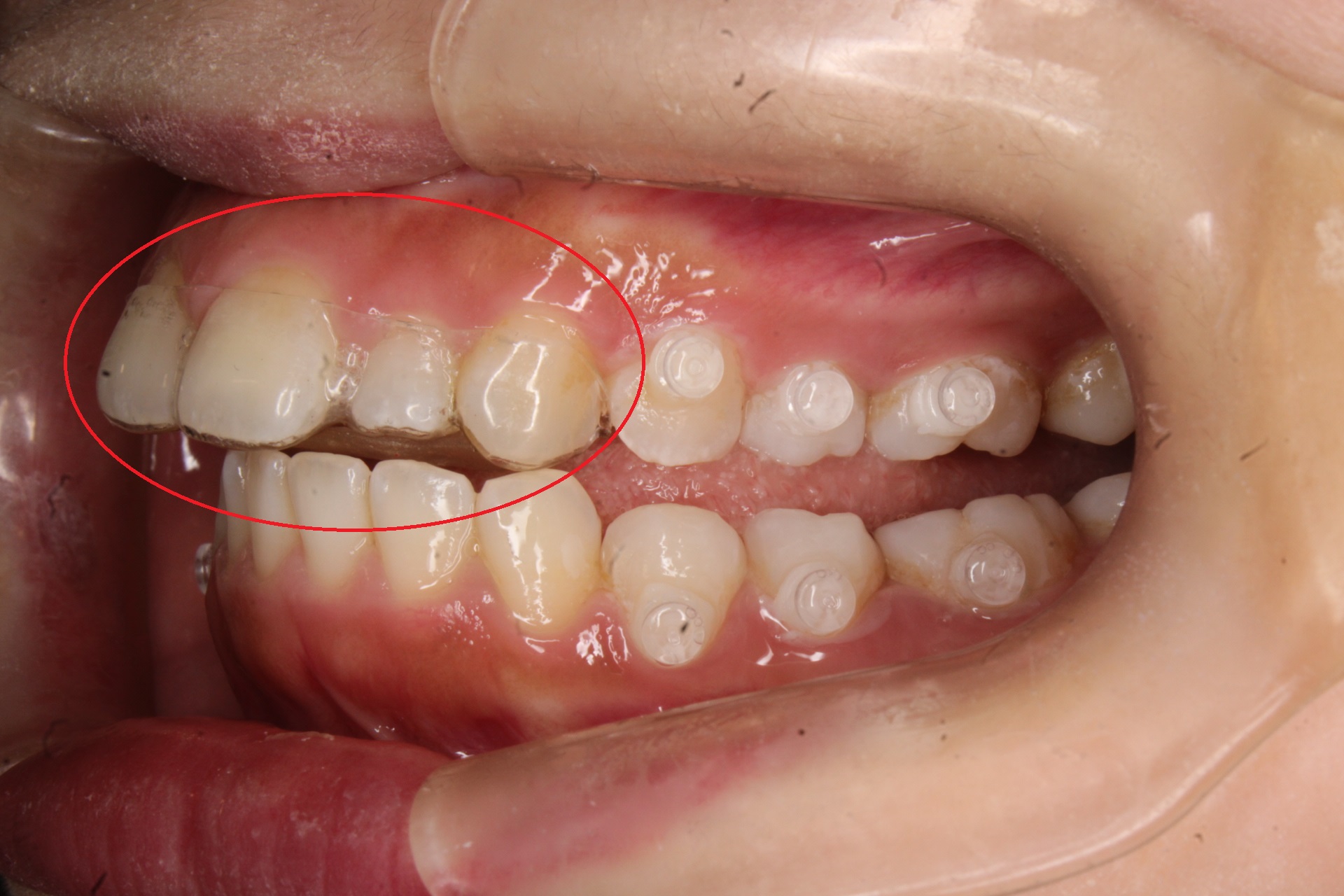 バイトアップCR