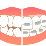 歯列矯正