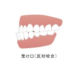 受け口　下顎前突