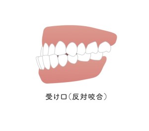 受け口　下顎前突