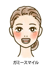 ガミースマイル
