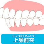 上顎前突