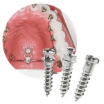 アンカースクリュー