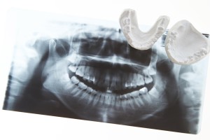 レントゲン　パノラマ