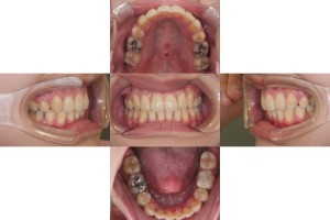 症例　治療終了