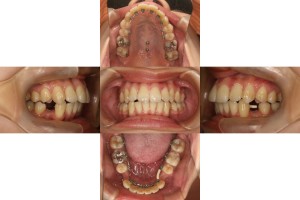 症例　６か月後