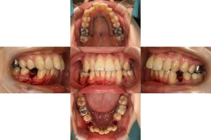 装置装着時　症例