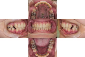 症例　１２か月後