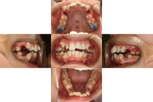 装置装着後　矯正