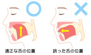 舌癖　舌トレーニング 舌スポット